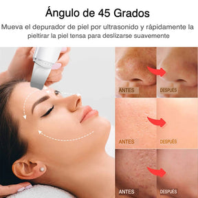 Exfoliador Ultrasónico Para Una Piel Radiante